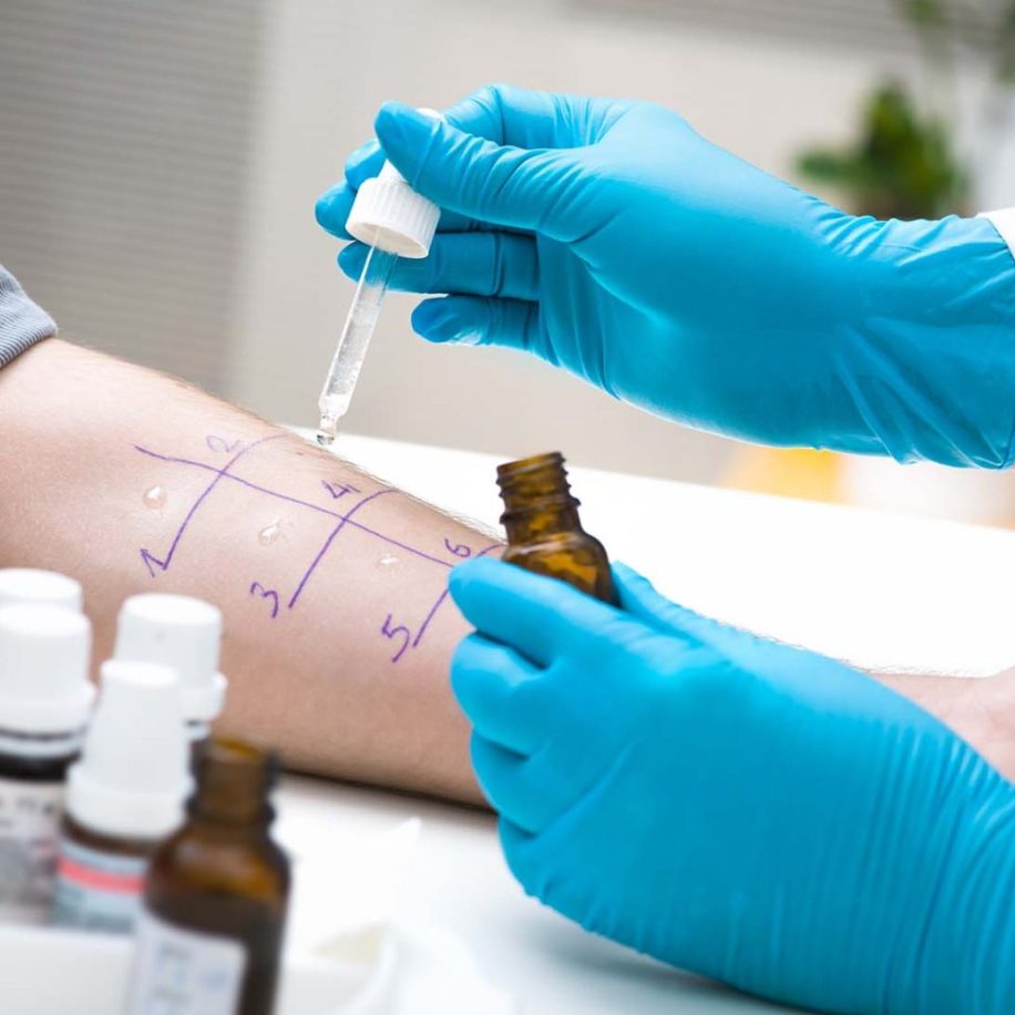 Skin-prick-allergy-test-aspect-ratio-1600-975